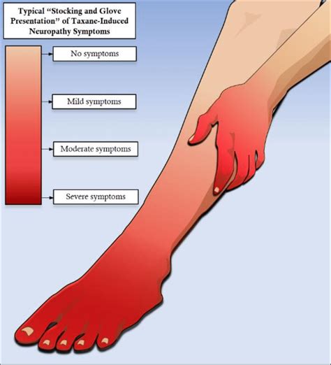 stocking glove syndrome|Understanding Peripheral Neuropathy